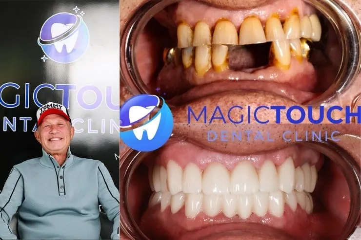 All on 4 dental implants in Antalya