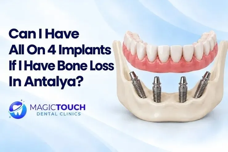 Illustration of four implants supporting a full arch of teeth in a jaw with reduced bone volume
