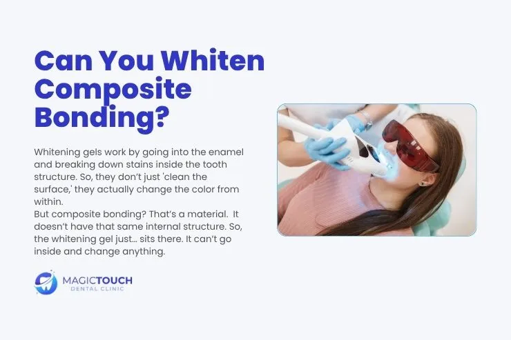 How long do composite bonding last?