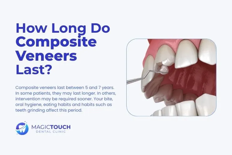 How long do composite bonding last?