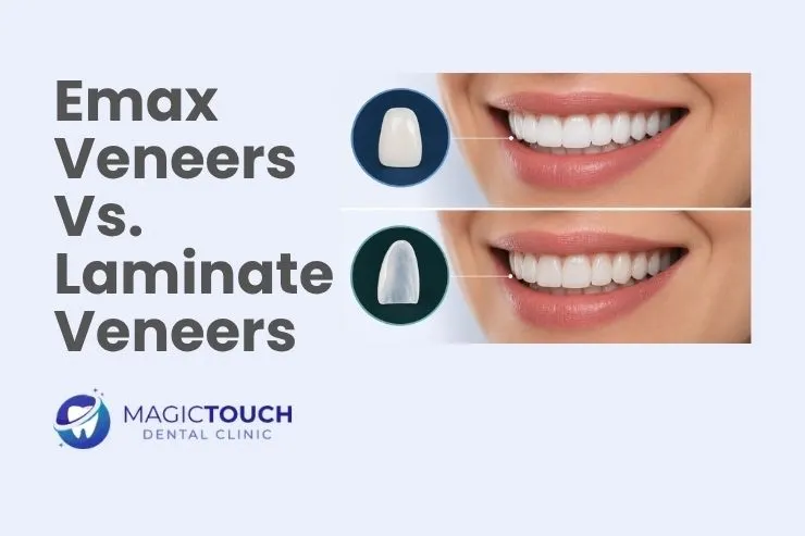 Emax veneers vs. Laminate veneers