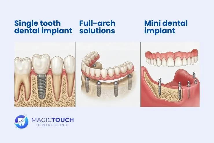 What are the types of dental implants?