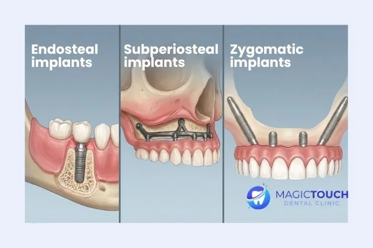 What are the types of dental implants?