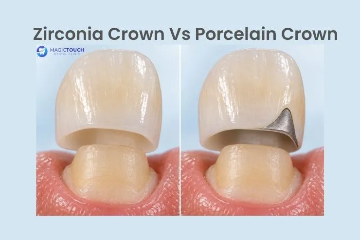Zirconia crown and PFM porcelain crown comparison in Antalya