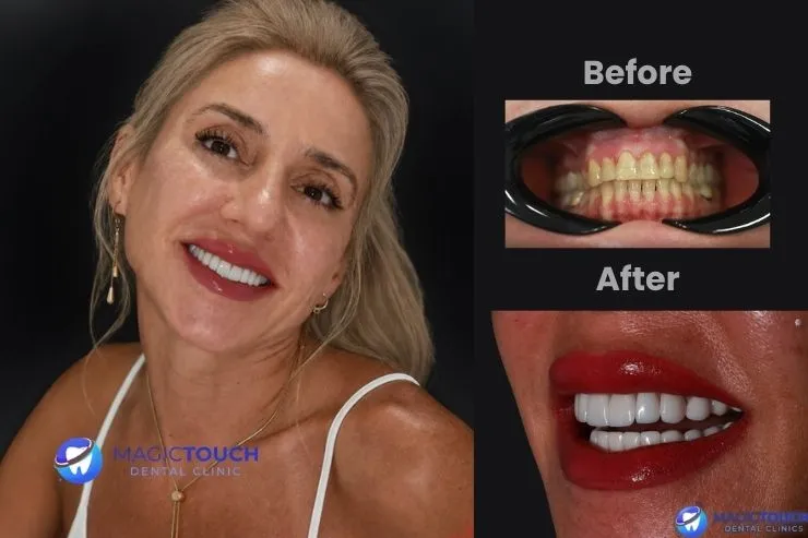 Antalya Emax veneers laminate veneers