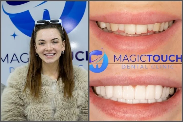 Zirconium crown in Antalya