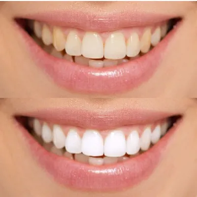 Teeth Whitening 7 Laser Teeth Whitening