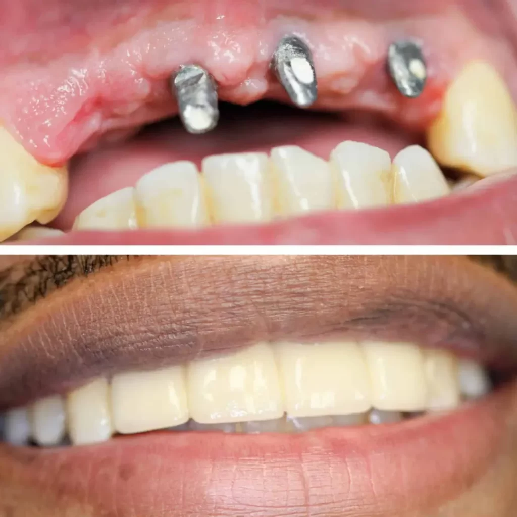 all on four implant 9 All on Four Implant