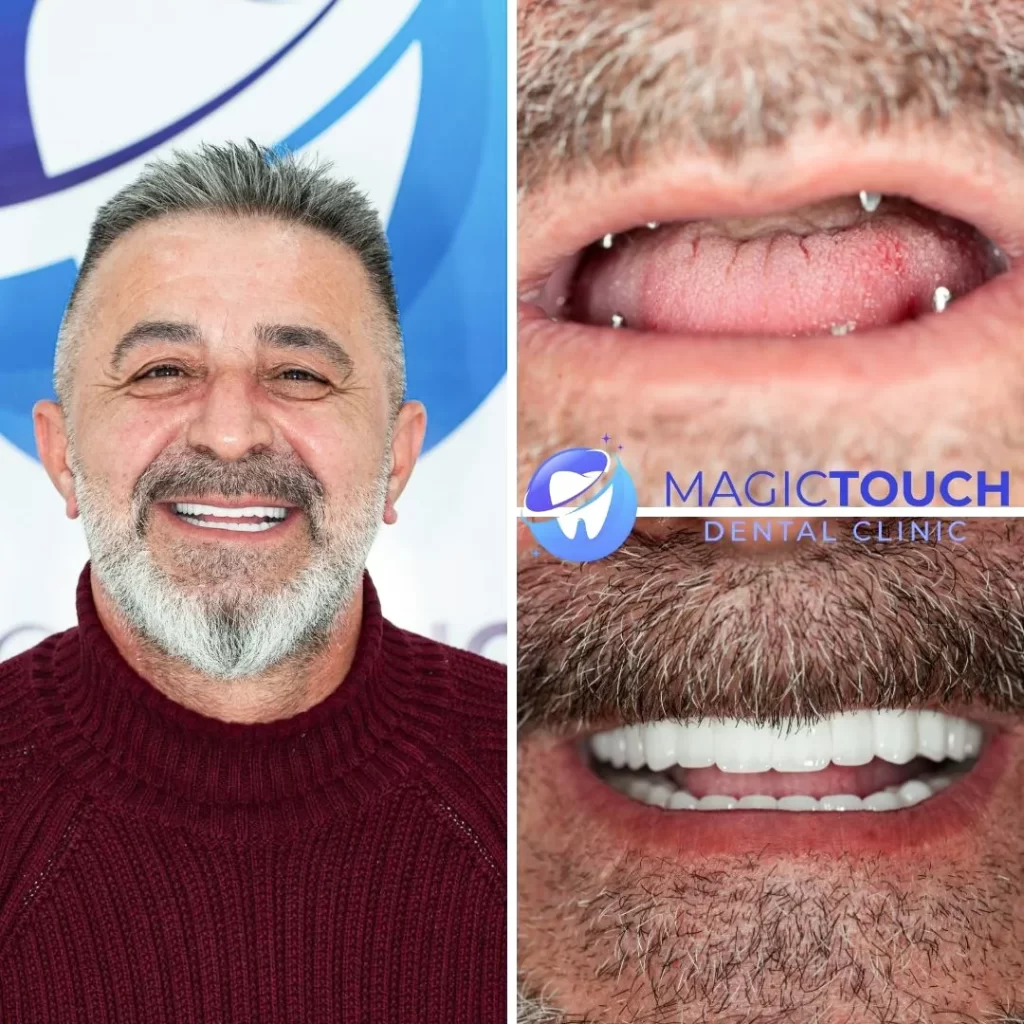 all on four dental implants in Turkey