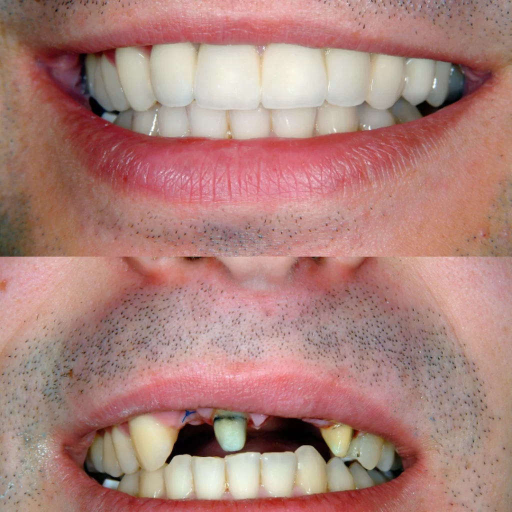 Tooth implants Turkey