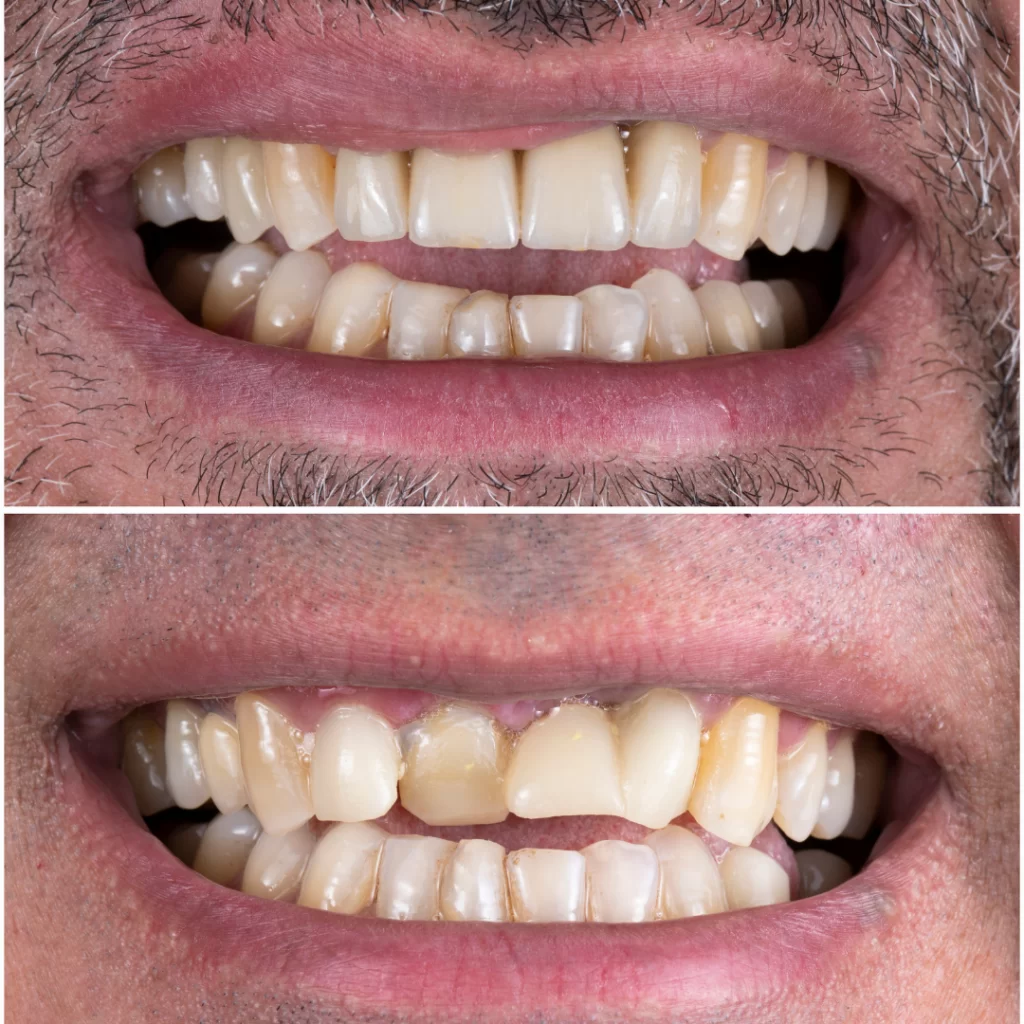 dental implant 4 1 Diş İmplantı