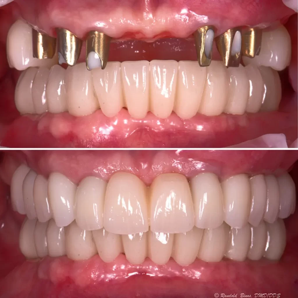 dental implant 5 1 Diş İmplantı