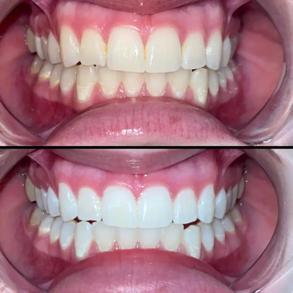 laser teeth white 00 Laser Teeth Whitening
