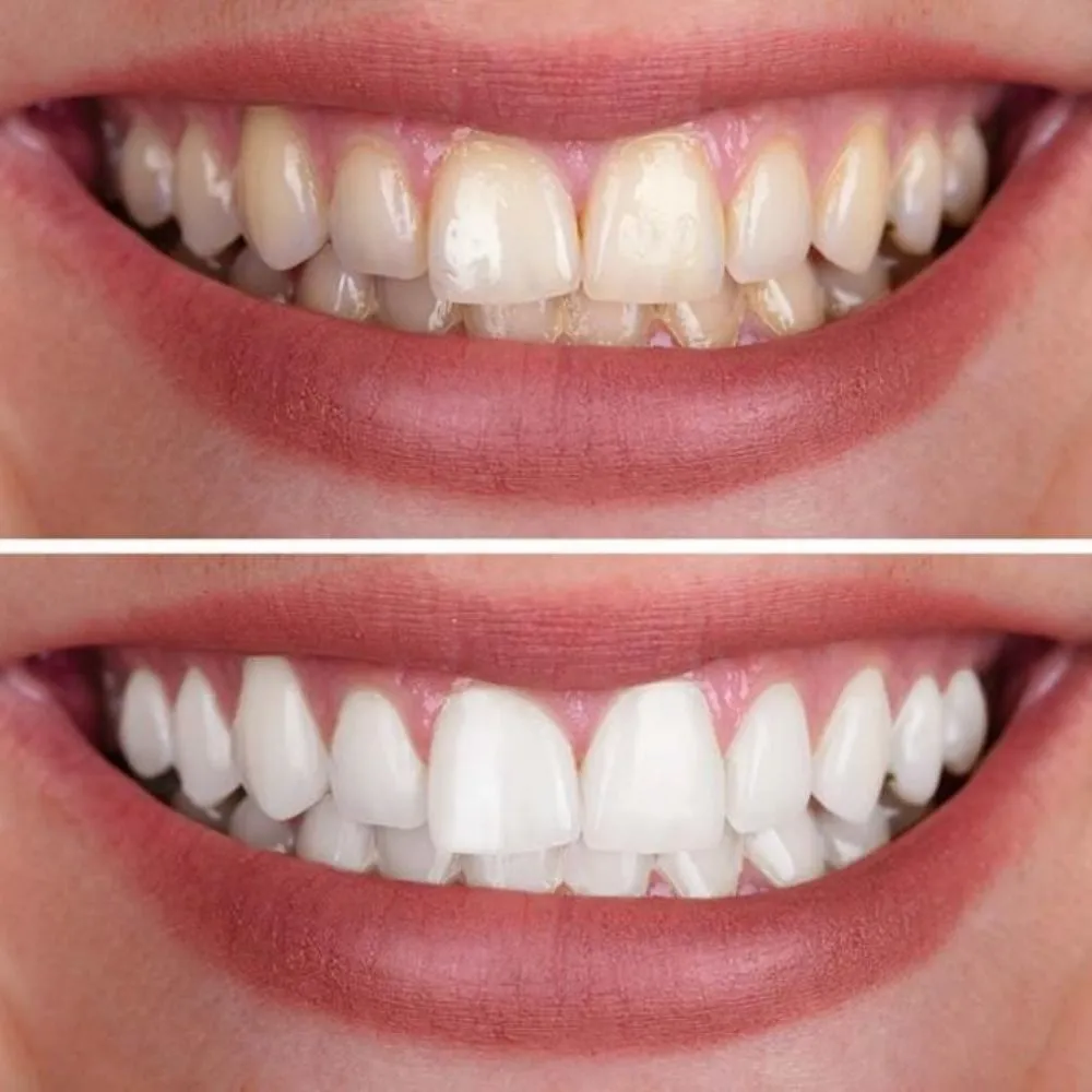 white teeth 14 Laser Teeth Whitening