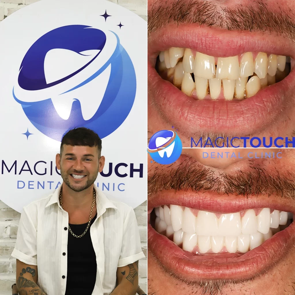 Smile design makeover