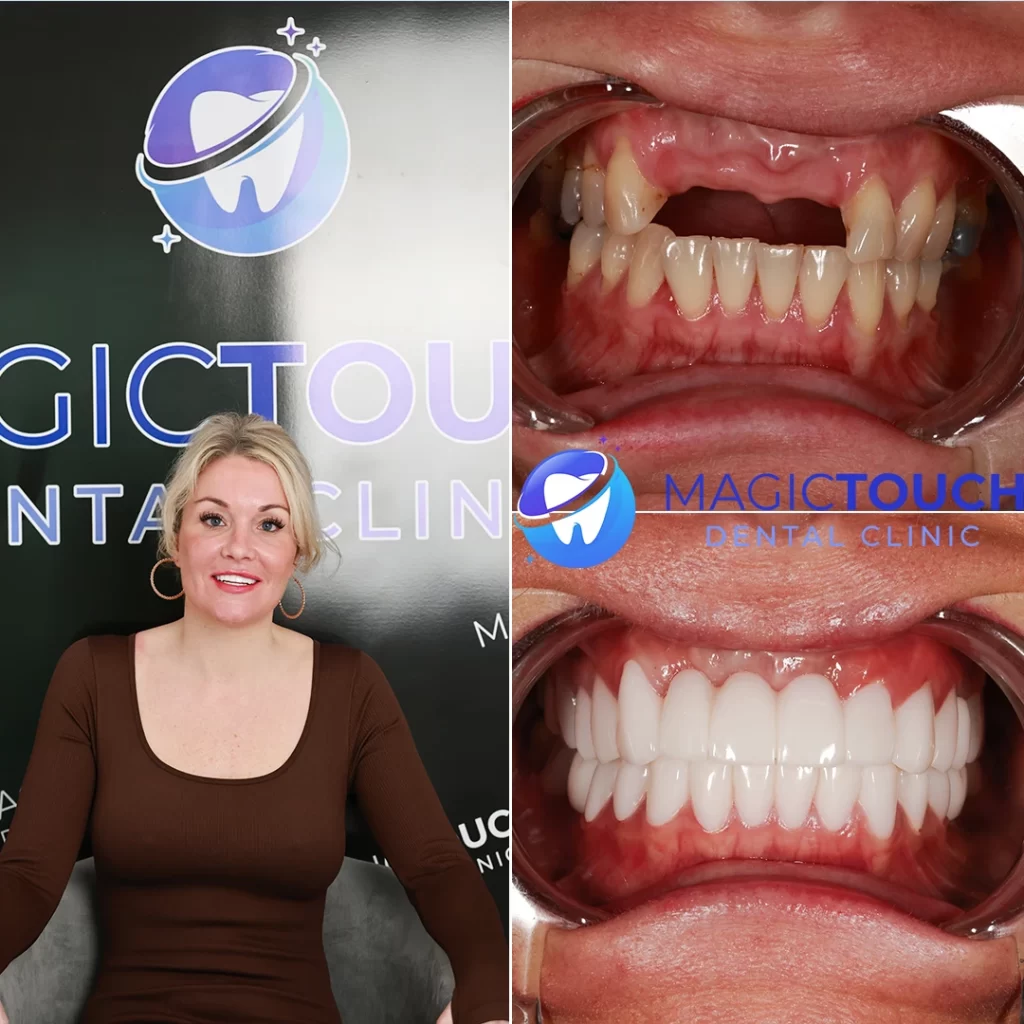 gemma All on Four Implant