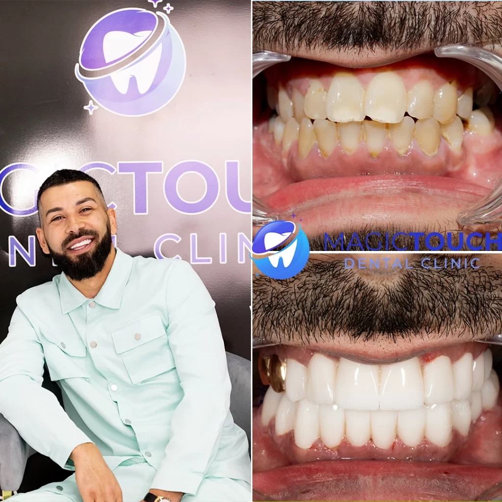 Zirconium veneers before and after