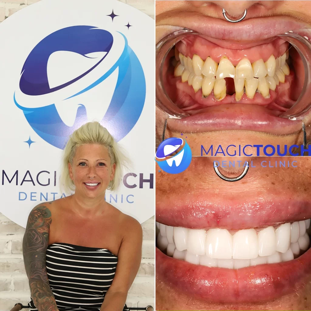 dental implants Antalya